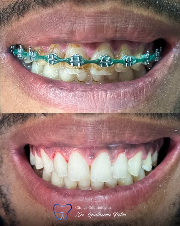 Caso clínico realizado na Clínica Odontológica Dr. Guilherme Peter 4
