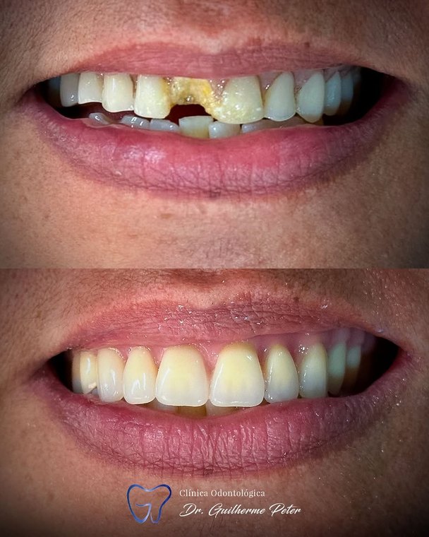 Caso clínico realizado na Clínica Odontológica Dr. Guilherme Peter 7